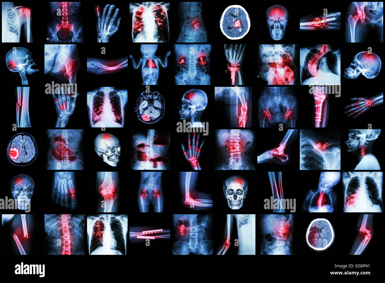 X-ray mehrere Krankheiten von Kindern und Erwachsenen (Schlaganfall, Arthritis, Frakturen, Tuberkulose, Gehirntumor, Darmverschluss, Ki Stockfoto