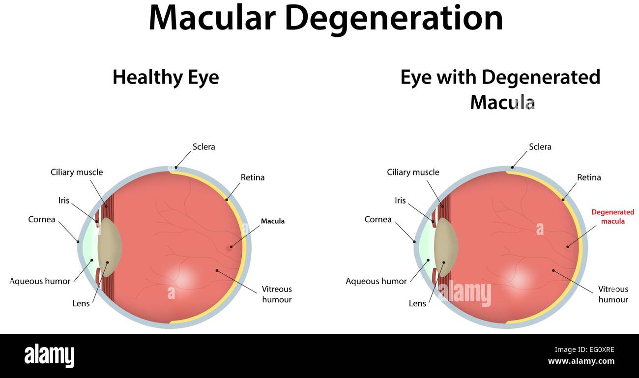 Makula-Degeneration Stock Vektor