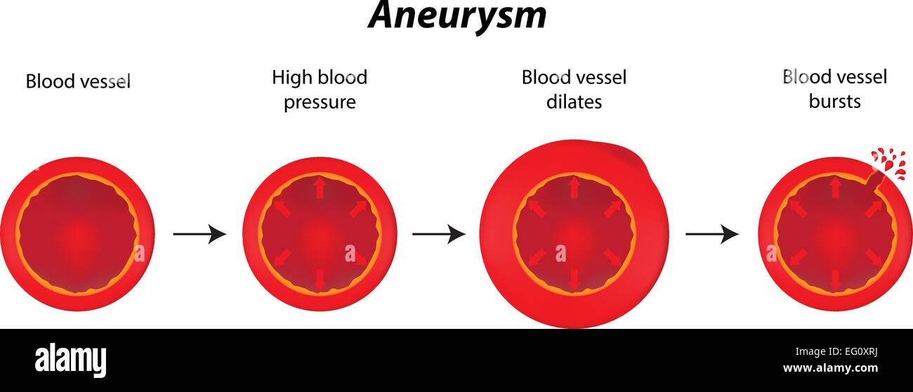 Aneurysma Stock Vektor