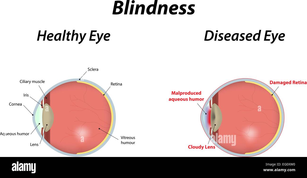 Blindheit Stock Vektor