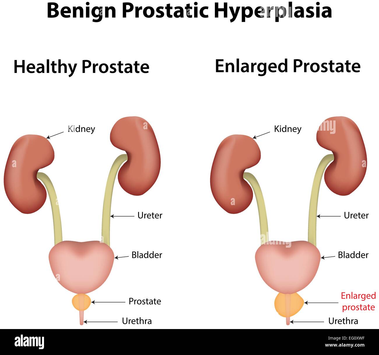 Benigne Prostatahyperplasie Vektor Abbildung Bild 78697067 Alamy