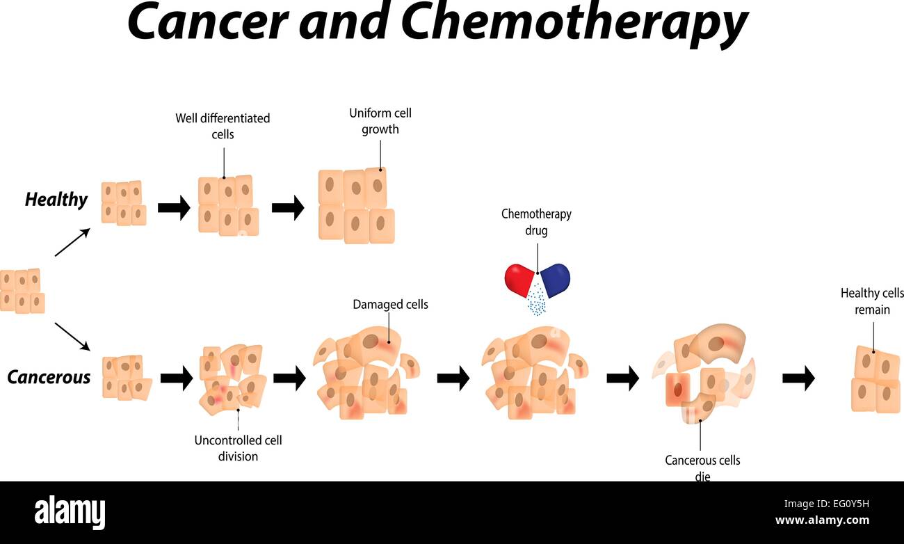 Krebs und Chemotherapie Stock Vektor