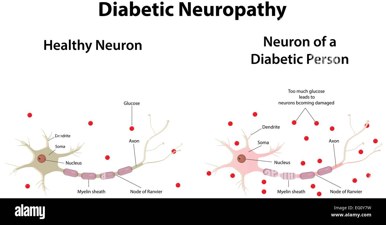 Diabetische Neuropathie Stock Vektor