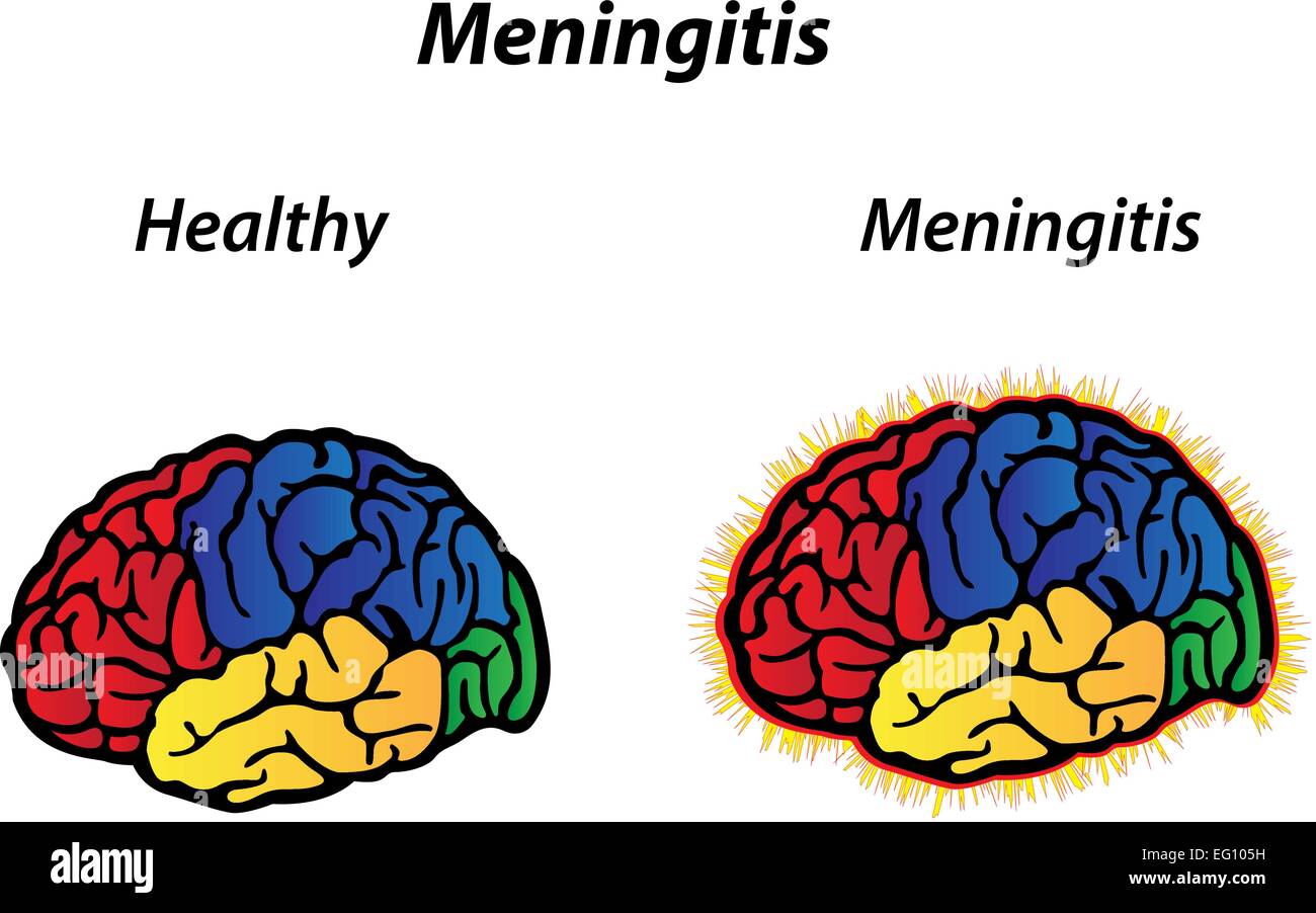 Meningitis Stock Vektor