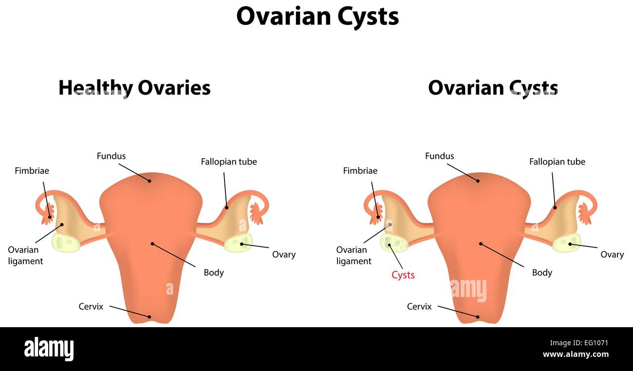 Eierstock-Zysten Stock Vektor