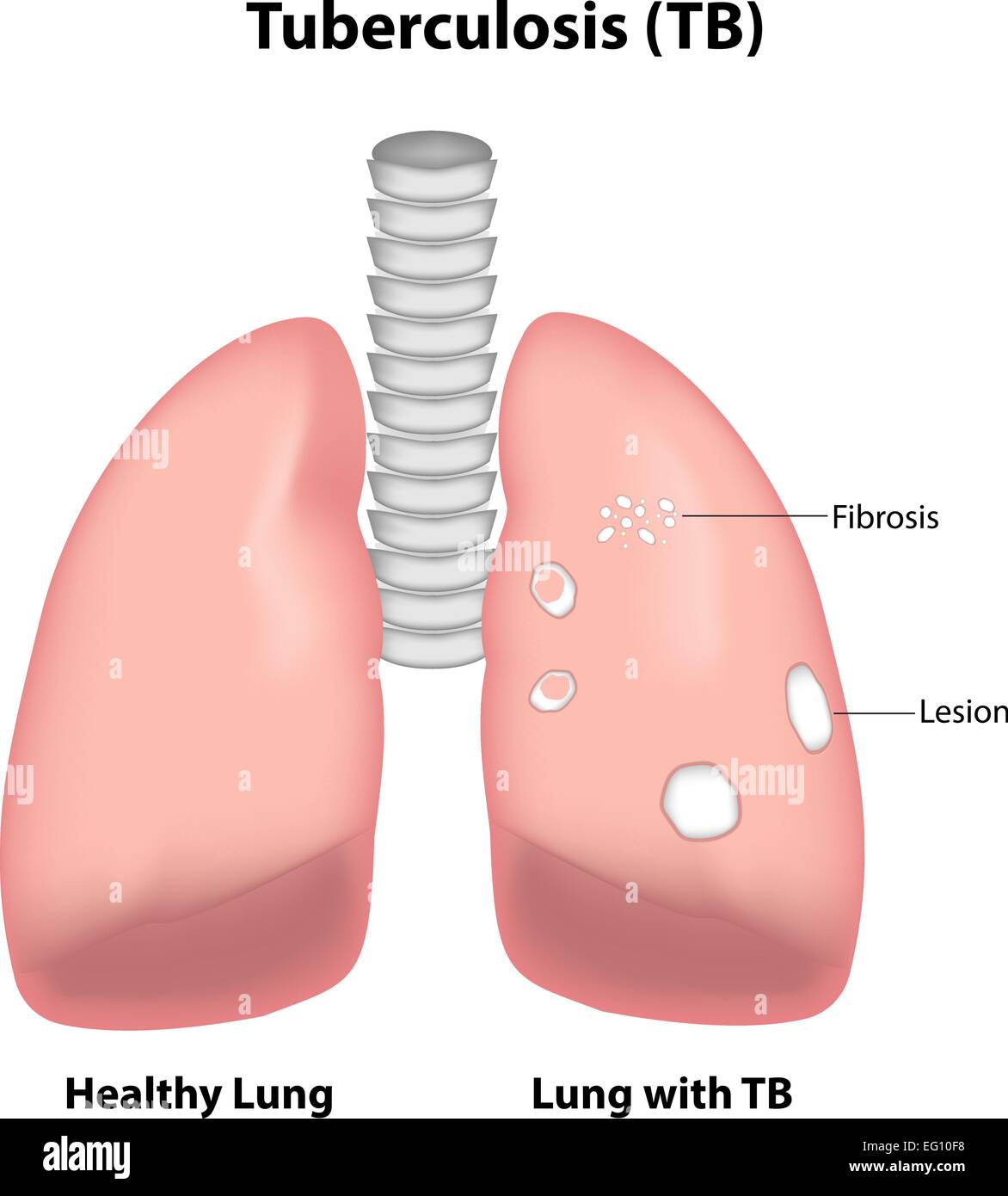 Tuberkulose (TB) Stock Vektor