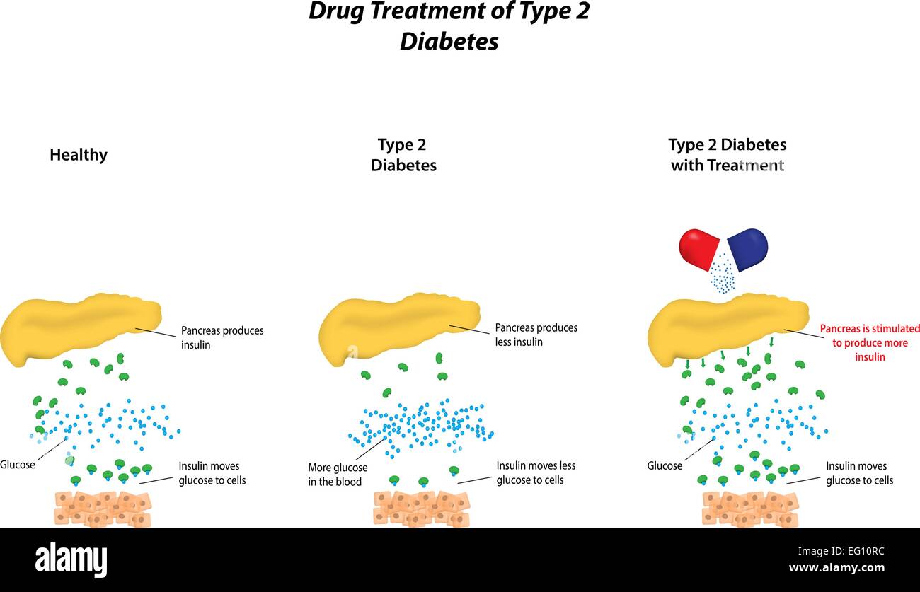 Medikamentöse Behandlung des Typ 2 Diabetes Stock Vektor