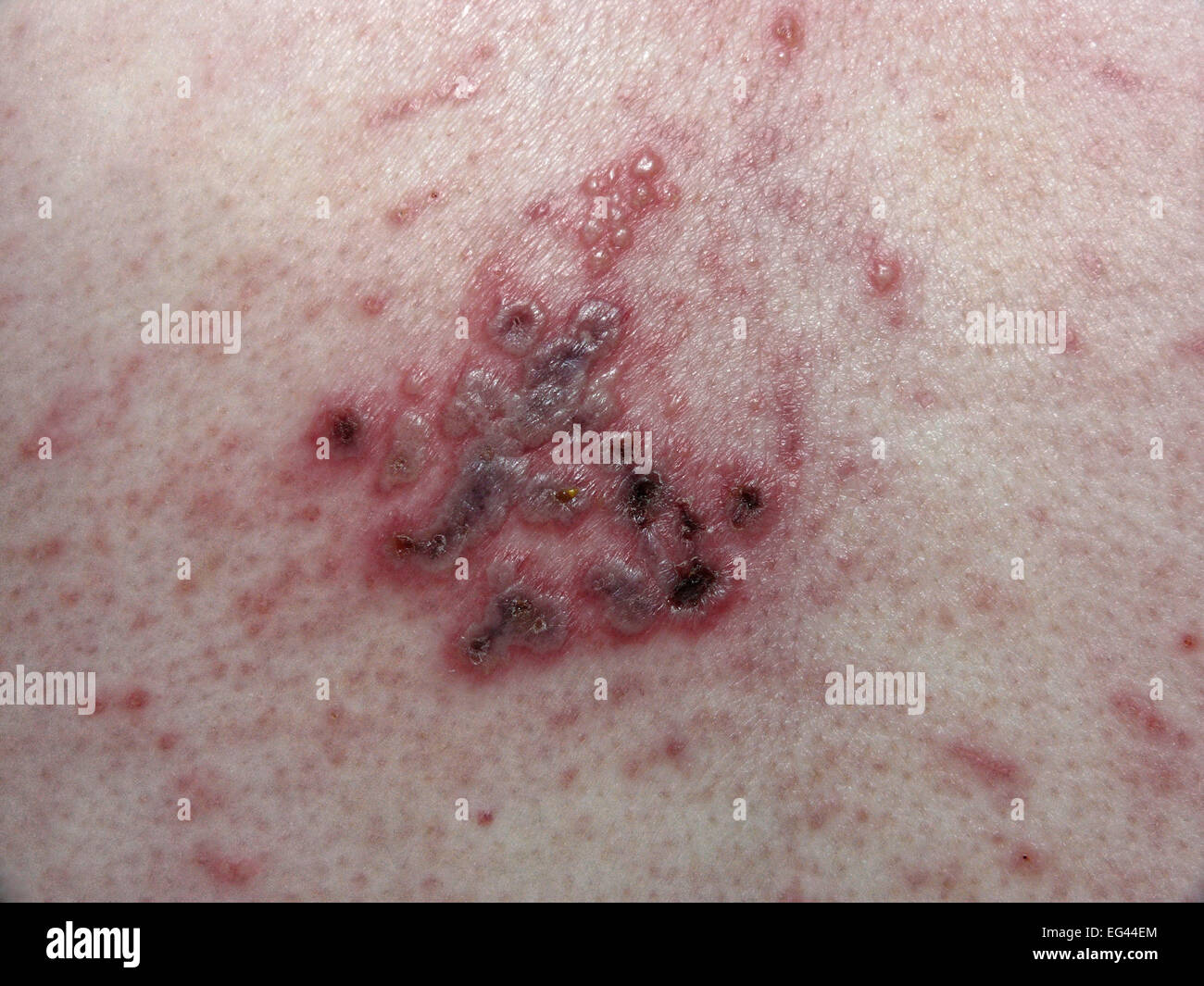 Herpes Zoster Fotos Und Bildmaterial In Hoher Aufl sung Alamy