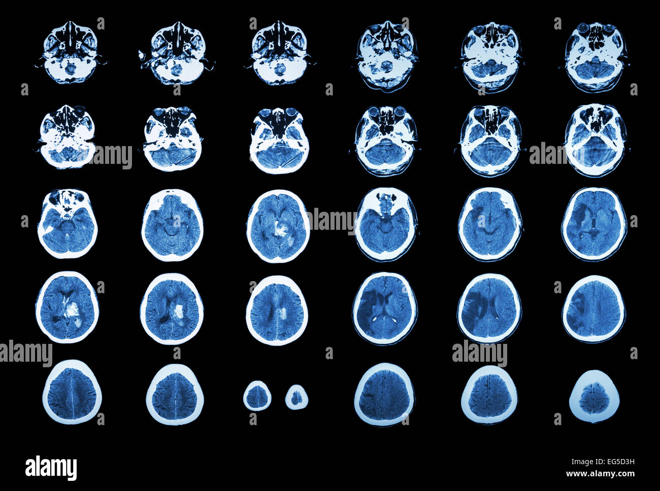 Hämorrhagischer Schlaganfall und ischämischen Schlaganfall.  CT-Scan des Gehirns: Intrazerebrale Blutung (3 linke Spalte), Hirninfarkt (3 Stockfoto
