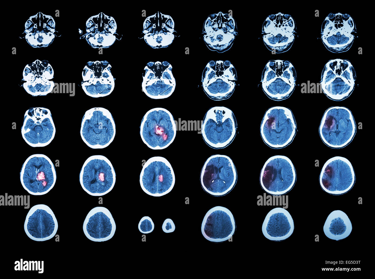 Hämorrhagischer Schlaganfall und ischämischen Schlaganfall.  CT-Scan des Gehirns: Intrazerebrale Blutung (3 linke Spalte, Hirninfarkt (3 Stockfoto