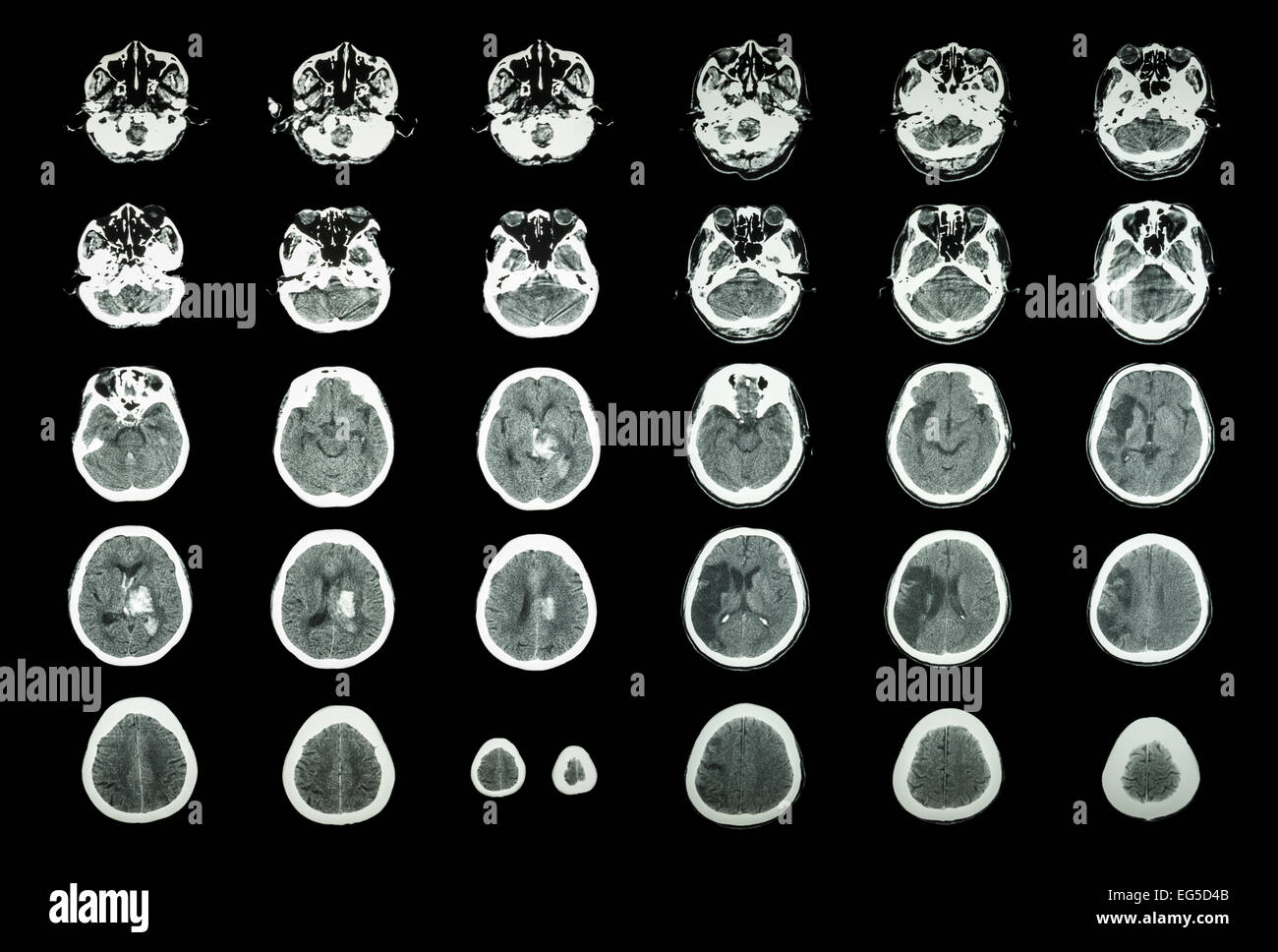 Hämorrhagischer Schlaganfall und ischämischen Schlaganfall.  CT-Scan des Gehirns: Intrazerebrale Blutung (3 linke Spalte), Hirninfarkt (3 Stockfoto