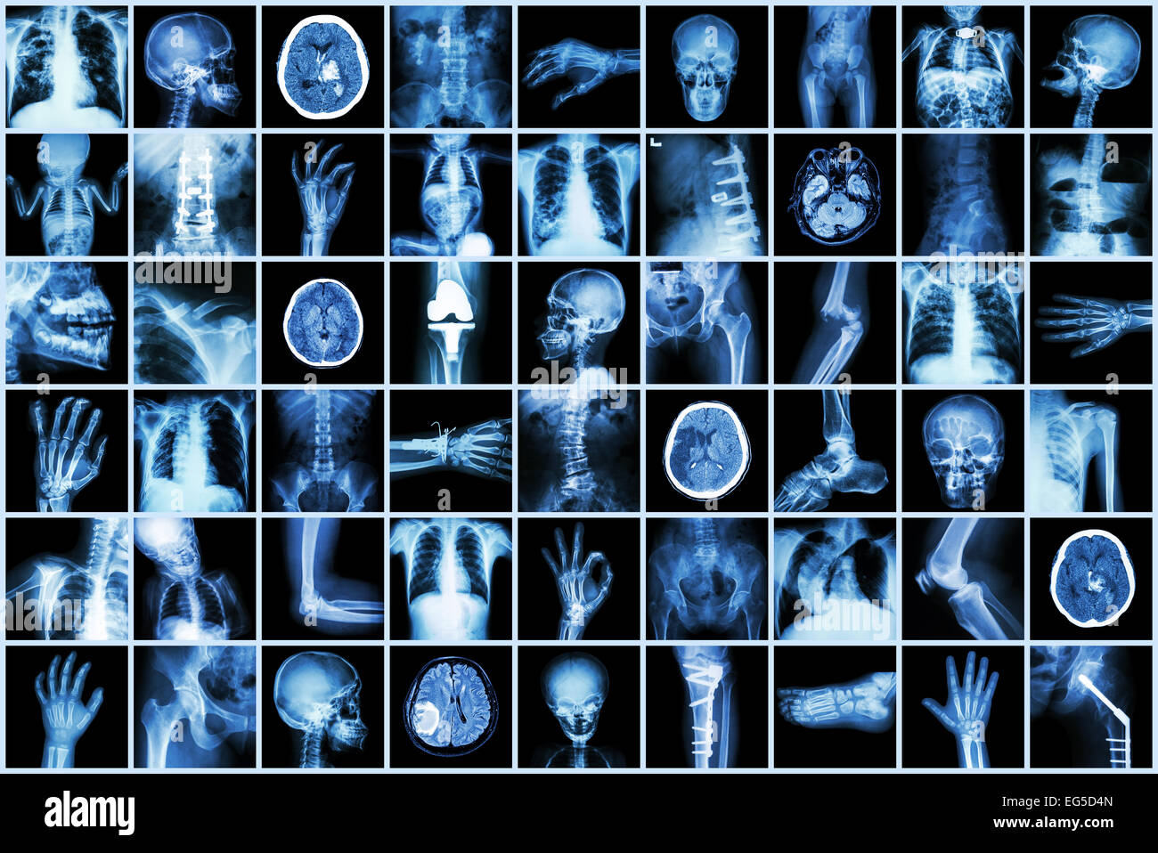 X-ray mehrere Teile von Erwachsenen und Kindern und Krankheit (Lungentuberkulose Schlaganfall Nierenstein Arthrose Knochen Fraktur Bogen Stockfoto