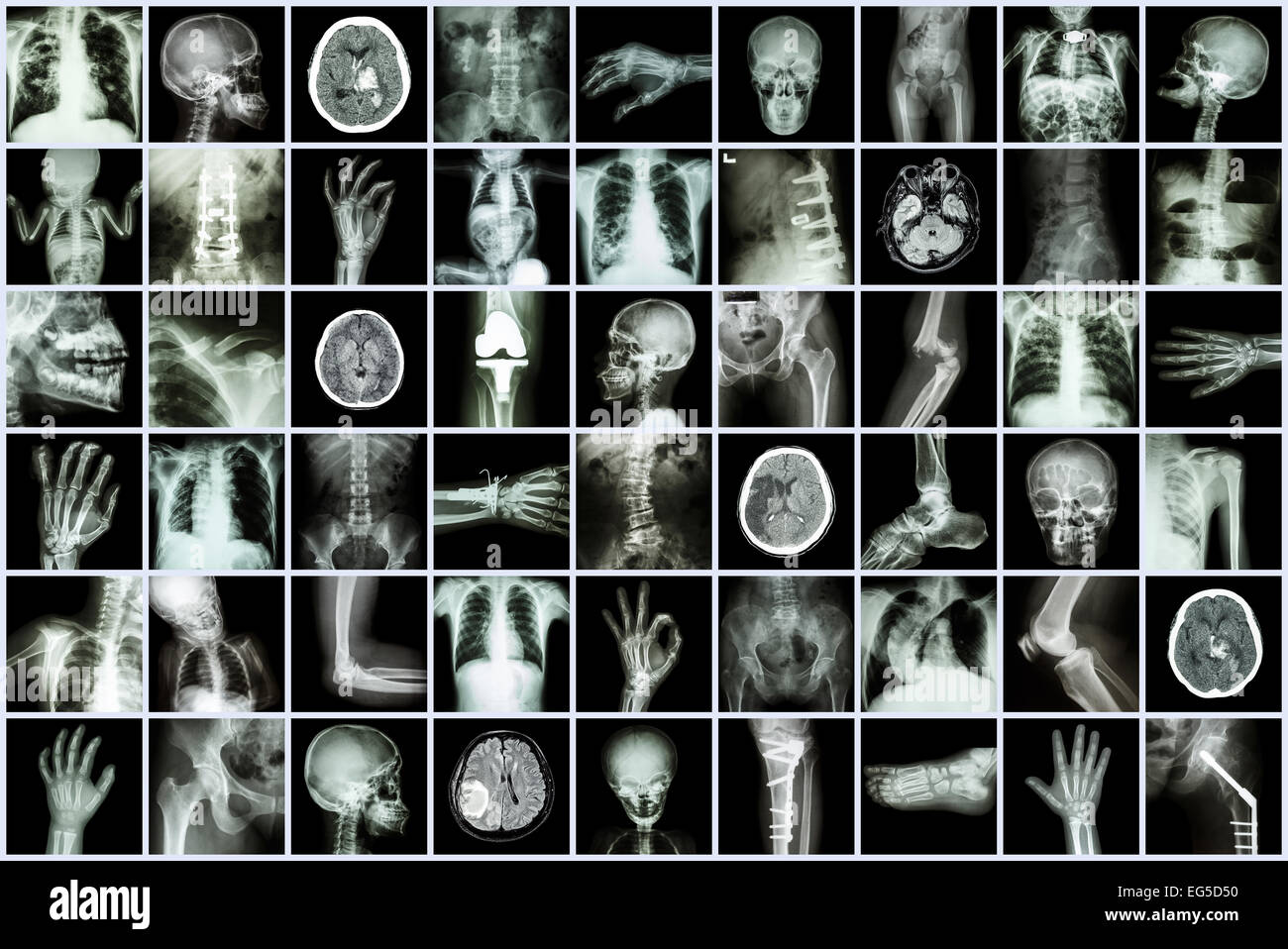 X-ray mehrere Teile von Erwachsenen und Kindern und Krankheit (Lungentuberkulose Schlaganfall Nierenstein Arthrose Knochen Fraktur Bogen Stockfoto