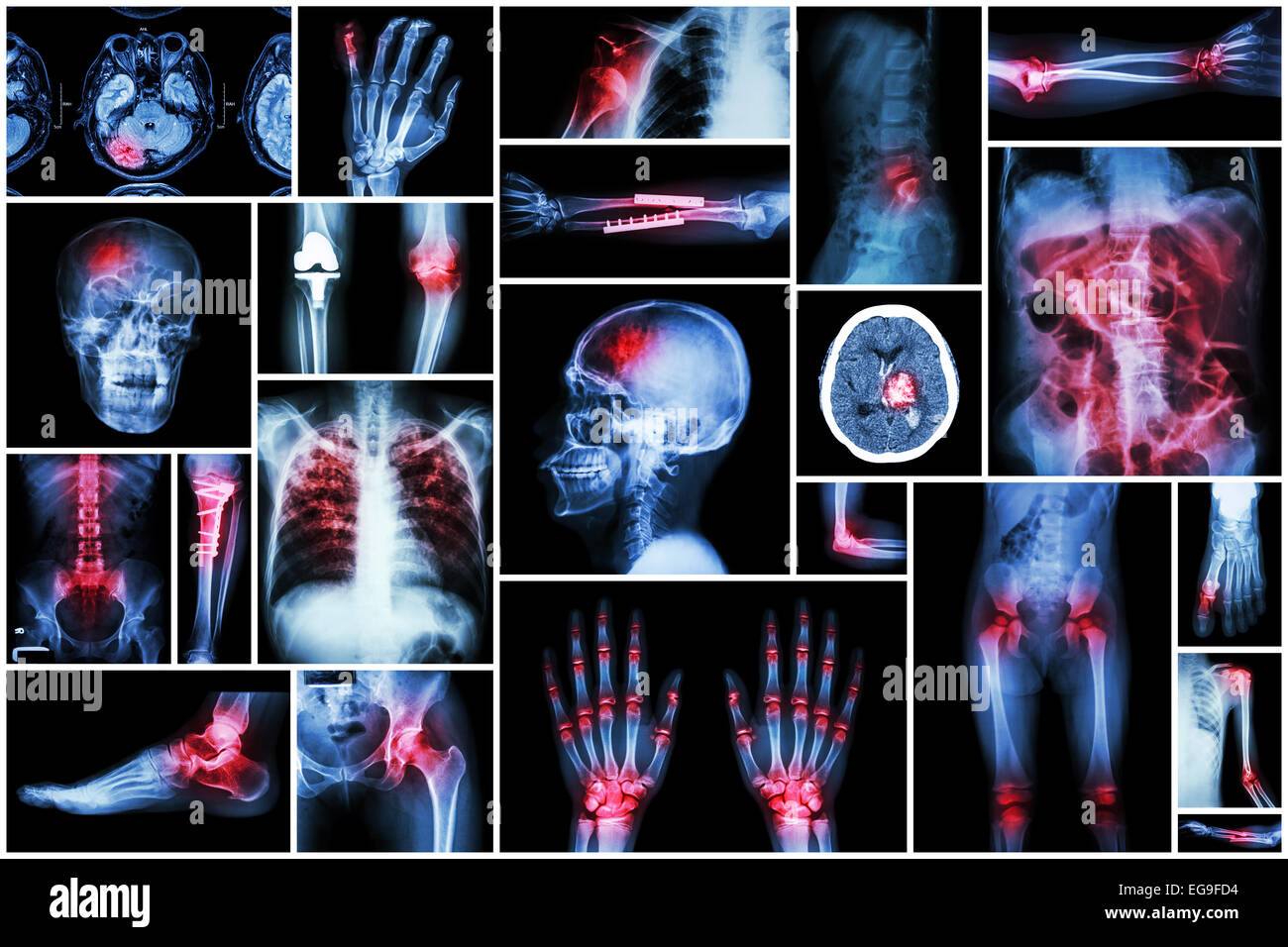 X-ray mehrere Erkrankung (Schlaganfall (CVA), Fraktur, Schulterluxation, Darmverschluss, rheumatoide Arthritis, Gicht, oste Stockfoto