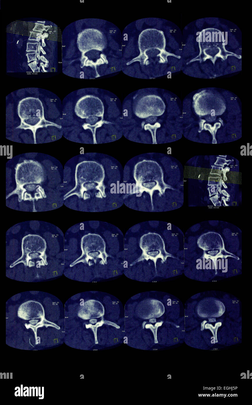 Lendenwirbel, Bandscheibenvorfall, Slice-Bildgebung, illustration Stockfoto