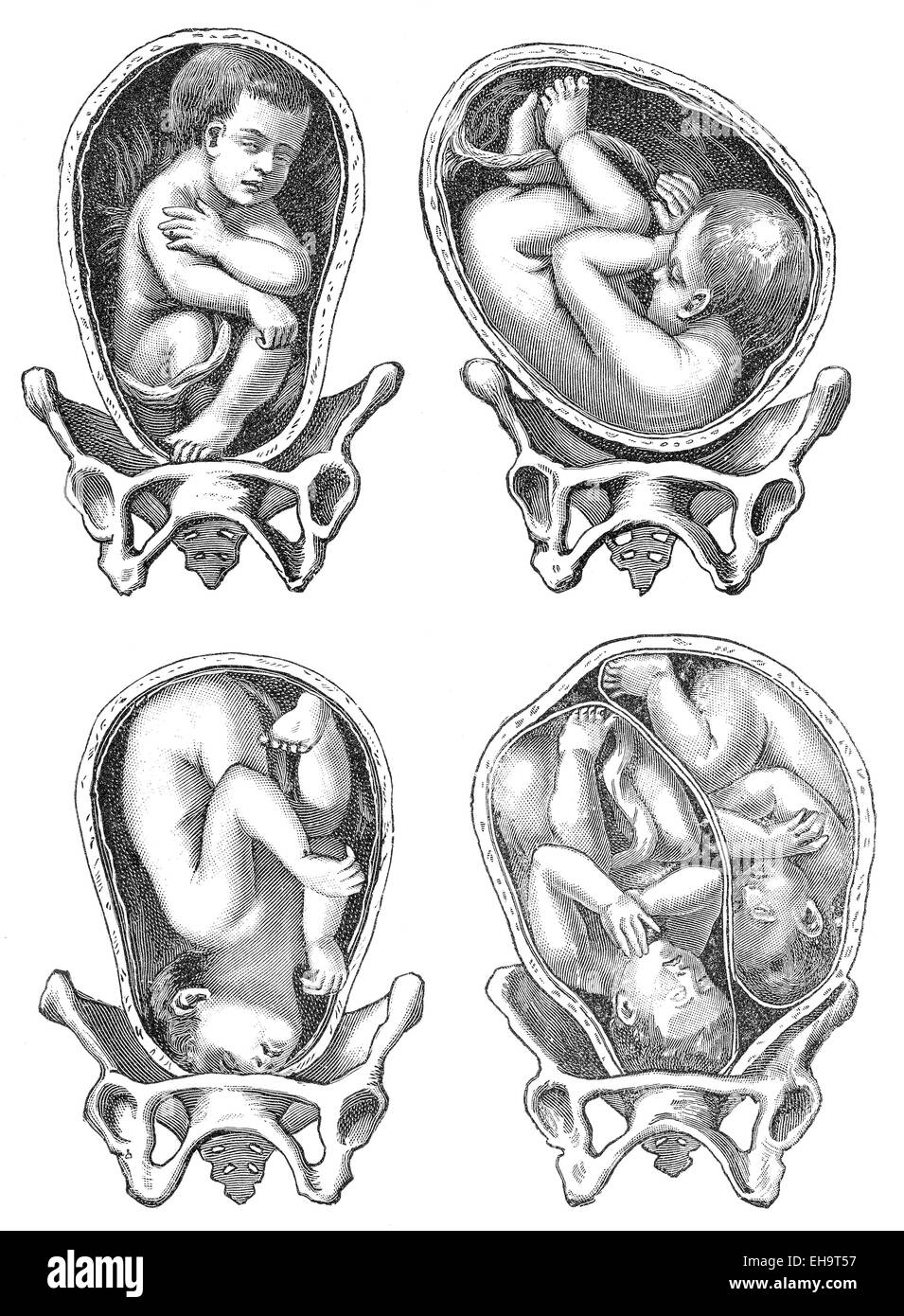 Geburt, die unterschiedlichen Positionen des Kindes bei der Geburt, Ratgeber Gesundheit, 19. Jahrhundert, Stockfoto
