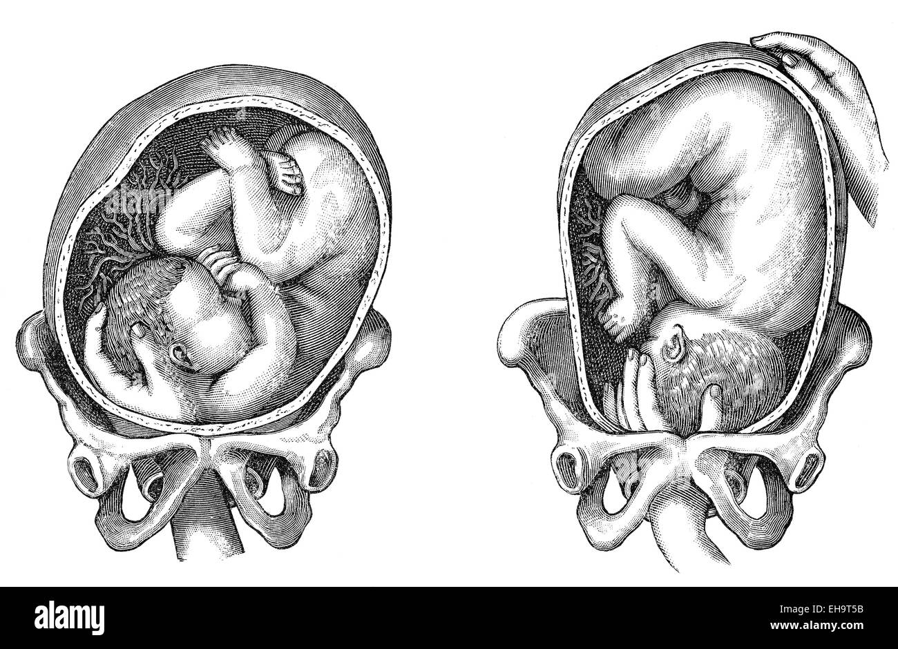 Geburt, die unterschiedlichen Positionen des Kindes bei der Geburt, Ratgeber Gesundheit, 19. Jahrhundert, Stockfoto