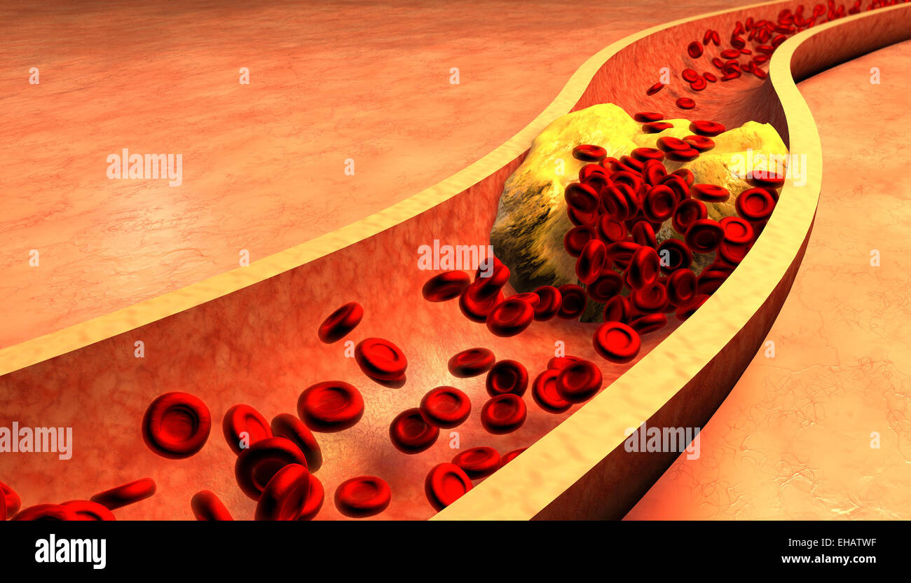 Verstopfte Arterie mit Thrombozyten und Cholesterin plaque Stockfoto