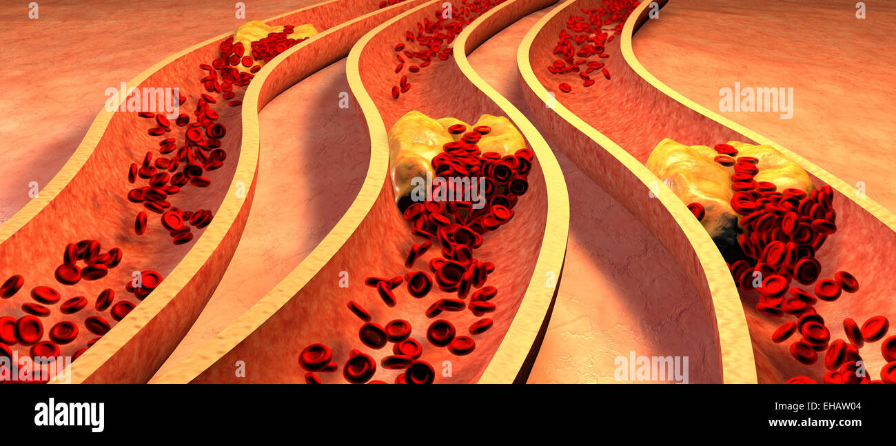 Verstopfte Arterie mit Thrombozyten und Cholesterin plaque Stockfoto
