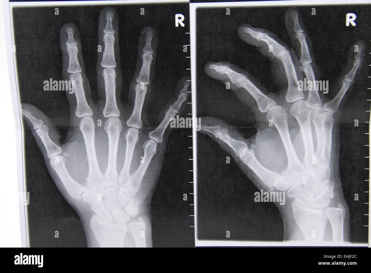 X-ray Abbildung einer Hand Stockfoto