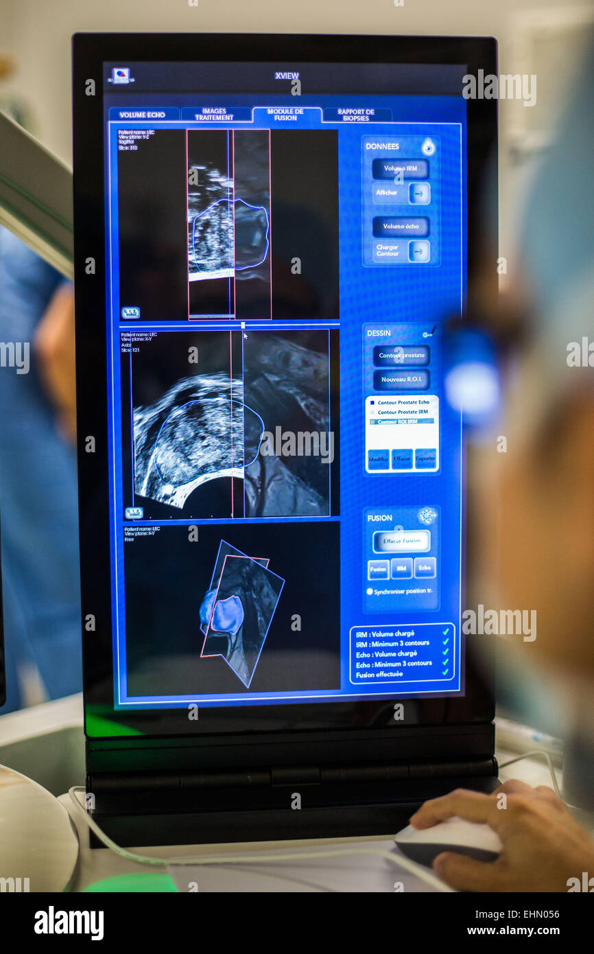 Behandlung des Prostatakrebses durch hohe Intensität Fokus Ultraschall (Focal-One). Montsouris Institut, Paris, Frankreich. Stockfoto