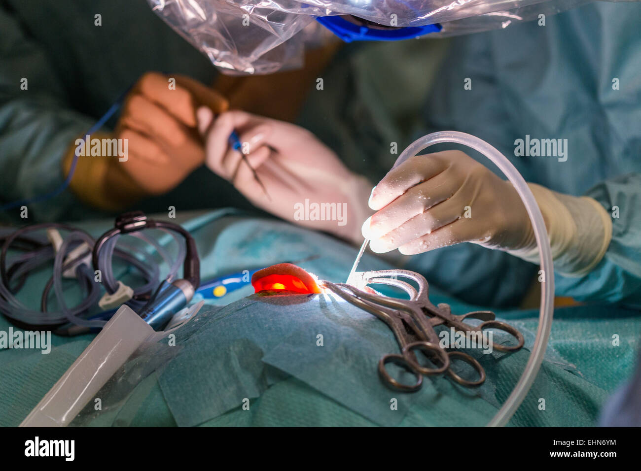 Chirurgen, die Durchführung von Cochlea-Implantatchirurgie, eine Operation mit Implantation von ein kleines elektronisches Gerät verwendet, um ein Gefühl von Klang, einer Gehörlosen Person, Krankenhaus in Limoges, Frankreich. Stockfoto