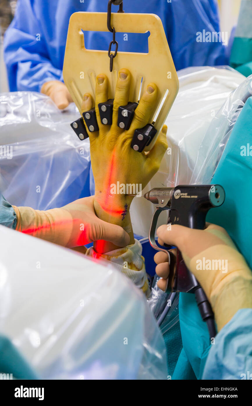 PIN auf ein gebrochenes Handgelenk-Arthroskopie, Jouvenet Klinik, Paris, Frankreich. Stockfoto