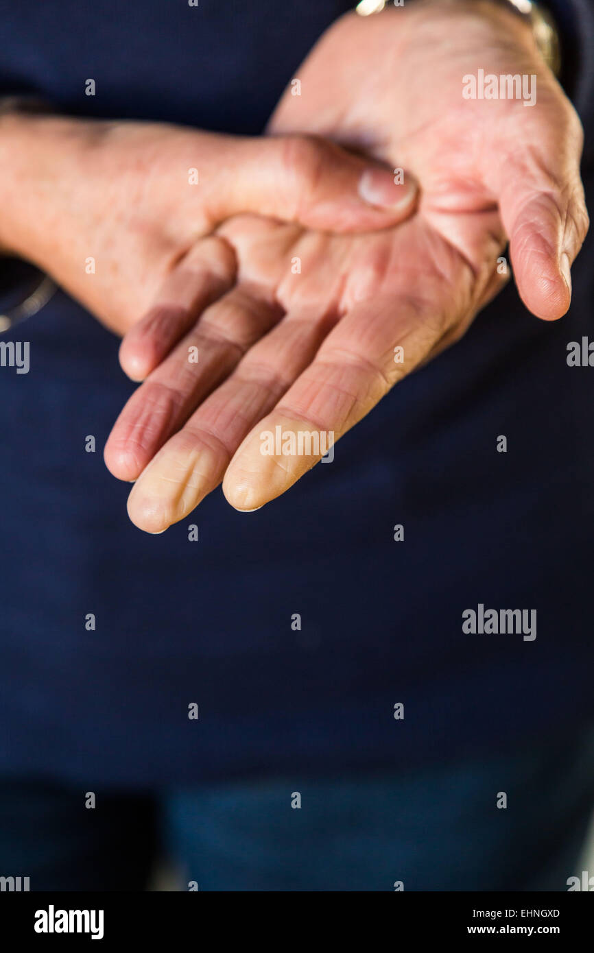 Frauenhand ein Raynaud Syndrom zugeschlagen. Stockfoto