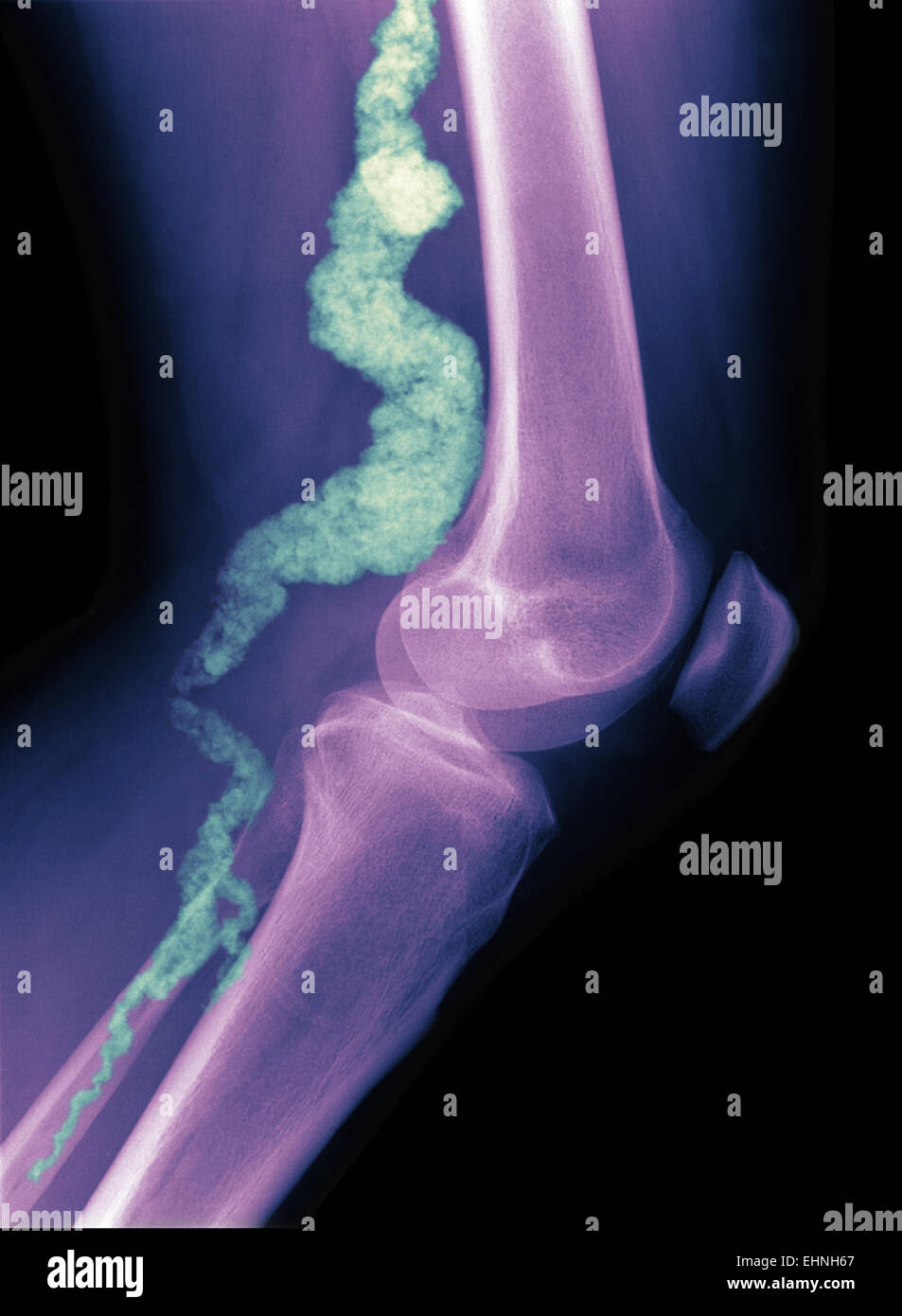 Eine Röntgenaufnahme Knie eines Patienten mit ACDC, eine seltene Verkalkung Störung zeigt Verkalkung in die Hauptschlagader, die Blutversorgung des Unterschenkels. Stockfoto