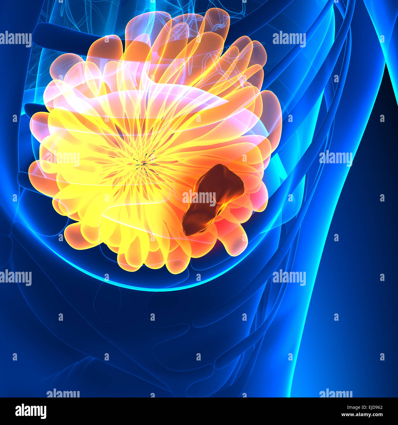 Brust-Krebs - weibliche Anatomie - Tumor highlight Stockfoto