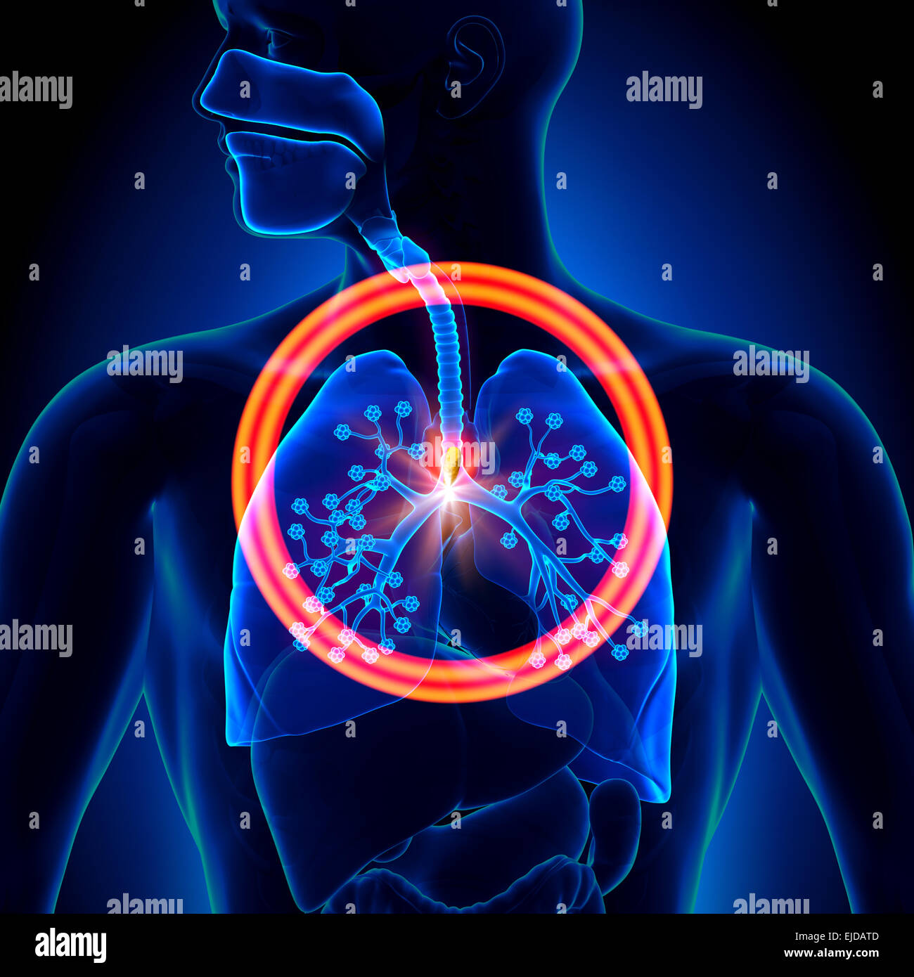 Lungen-Fremdkörper - inhaliert oder geschluckt Stockfoto