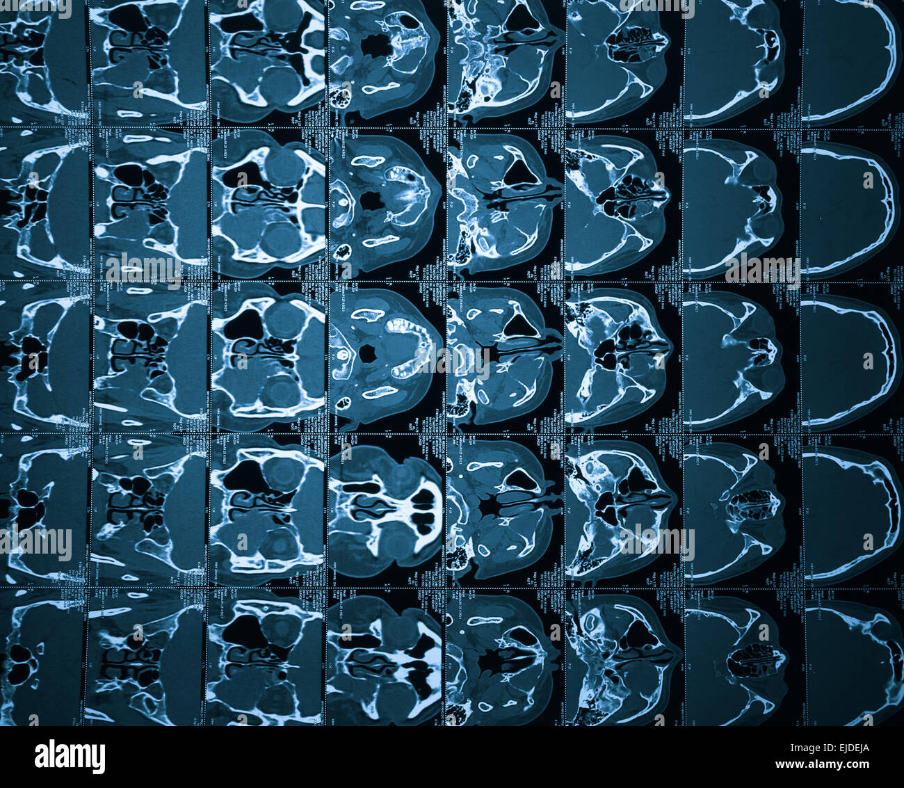 Gehirn-CT, Flash-Remake des Films Stockfoto