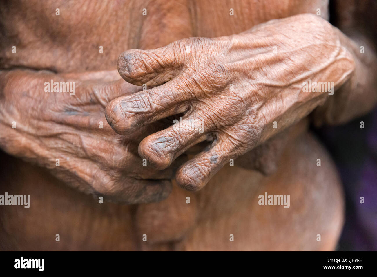 Dani Frau Finger abgehackt wegen Todesfall in der Familie, Wamena, Papua, Indonesien Stockfoto