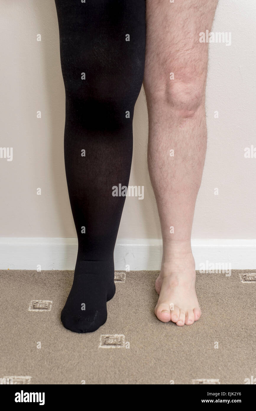 Männchen mit Lymphödem im rechten Bein Kompressionsstrumpf tragen Stockfoto