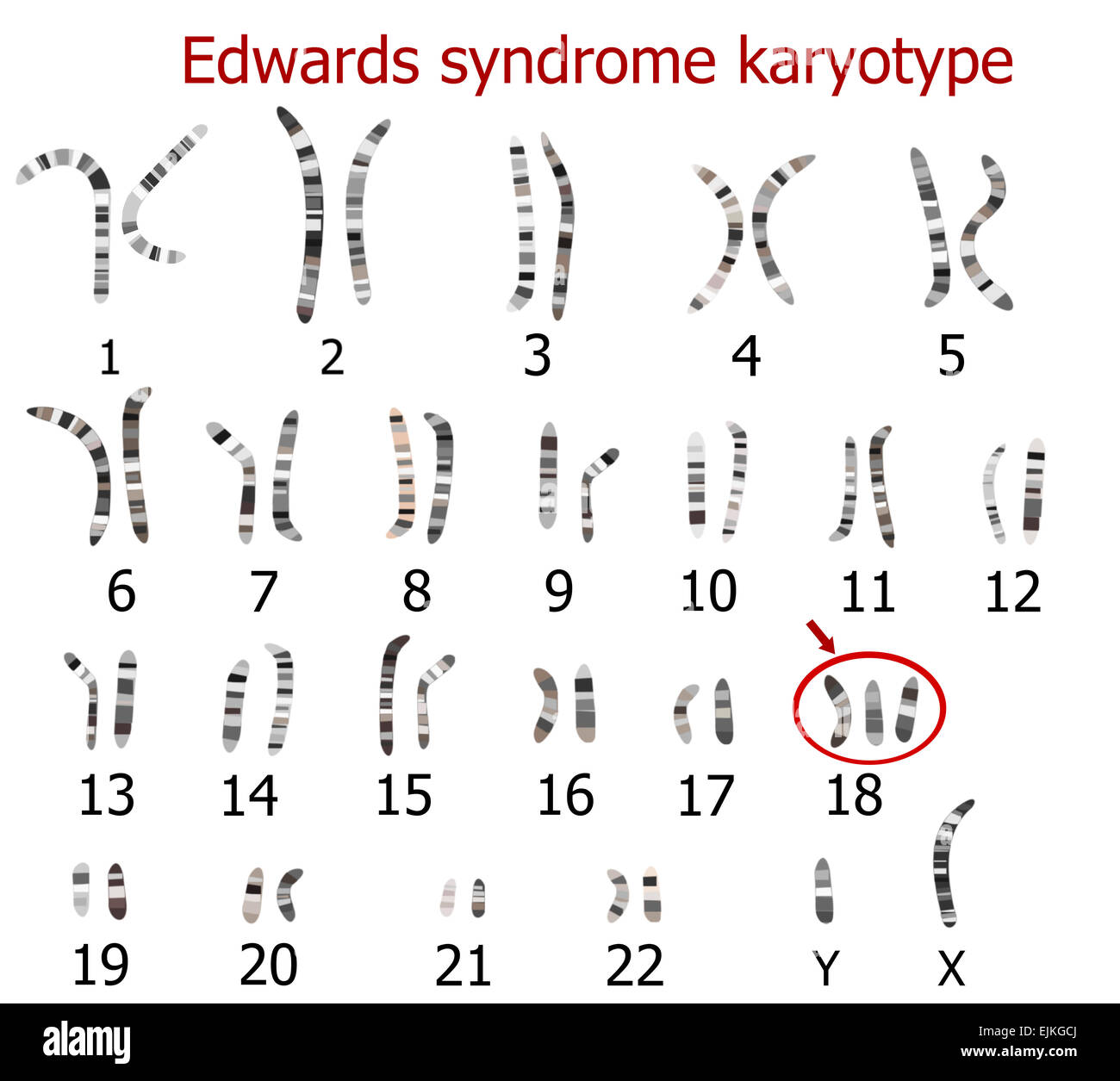 Edwards-Syndrom Karyotyp Stockfoto