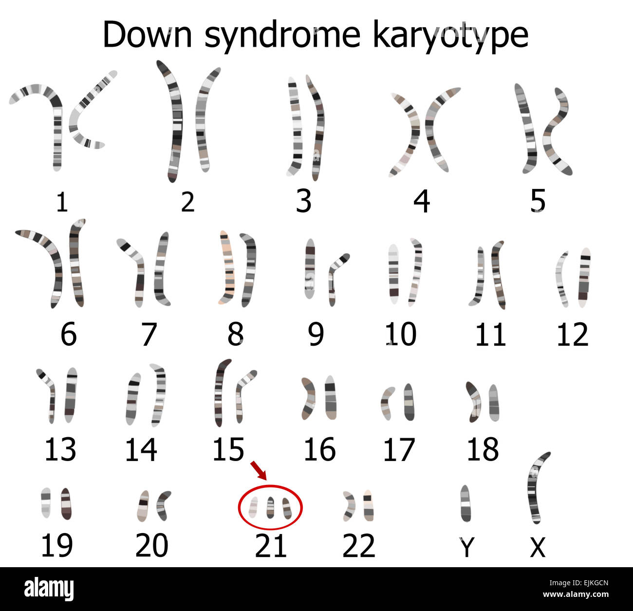 Down-Syndrom-Karyotyp Stockfoto