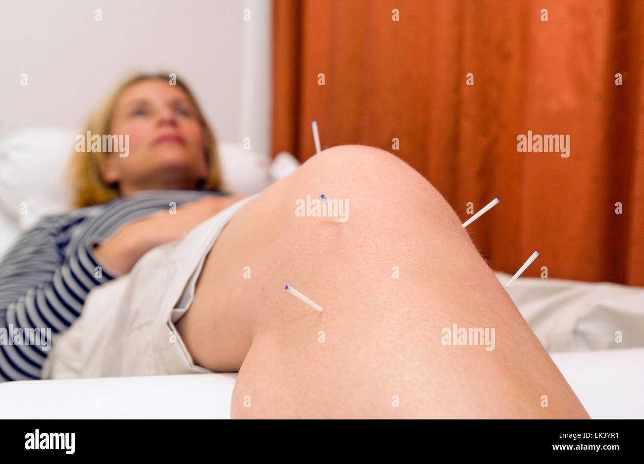 Akupunkturnadeln auf das Knie einer Frau Stockfoto