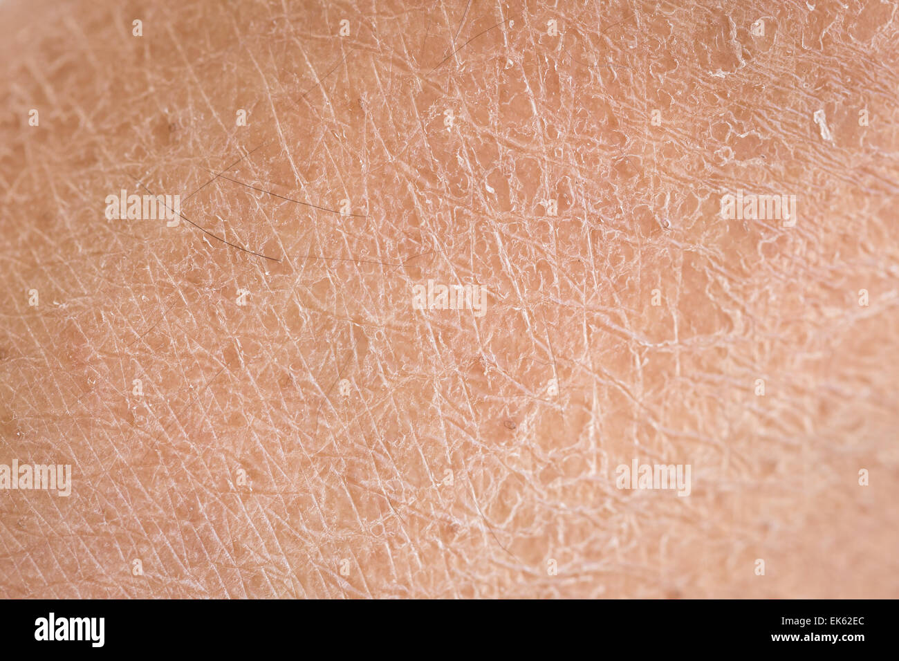 Makro-trockene Haut (Ichthyosis)-detail Stockfoto