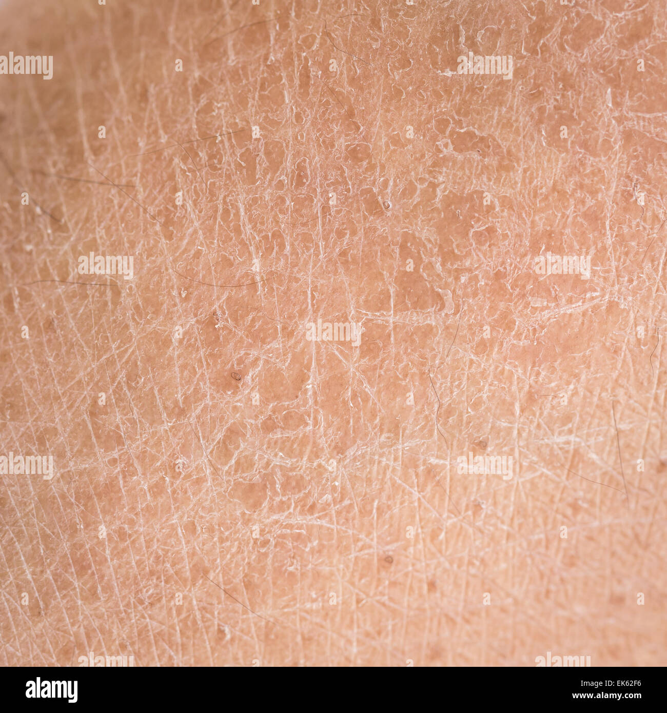 Makro-trockene Haut (Ichthyosis)-detail Stockfoto