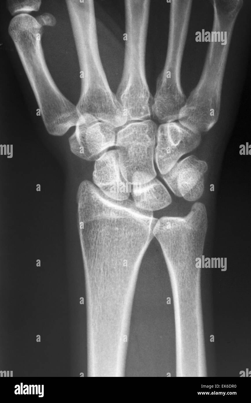 Menschliche handknochen -Fotos und -Bildmaterial in hoher Auflösung – Alamy