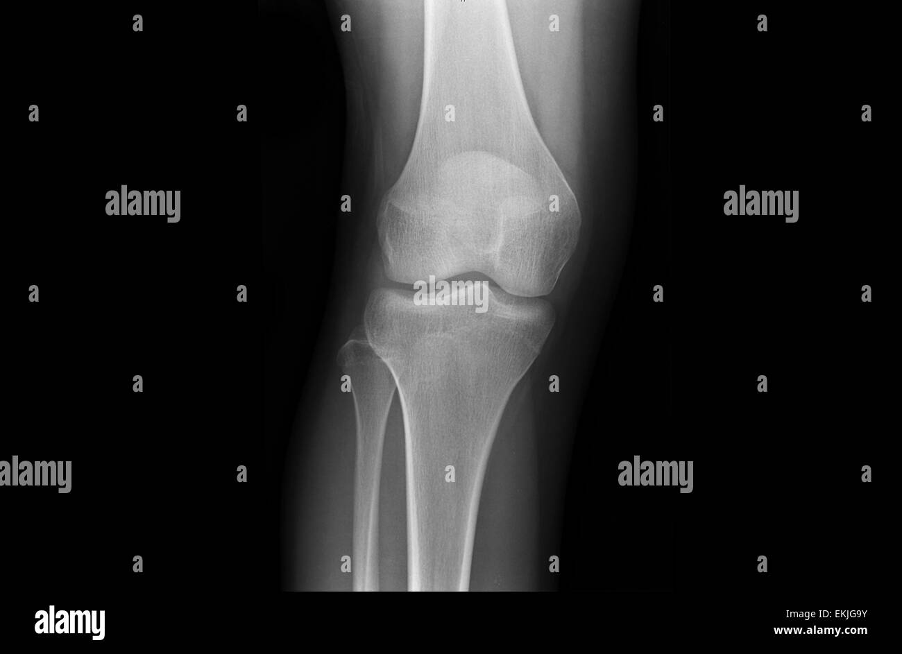 Kniegelenke eines Jugendlichen über x-ray Stockfoto