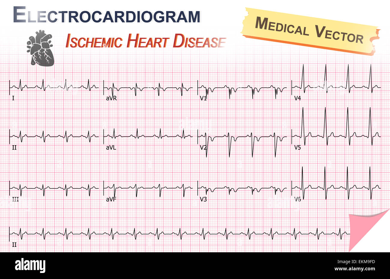 Elektrokardiogramm (EKG, EKG) Ischämische Herzkrankheit (Herzinfarkt