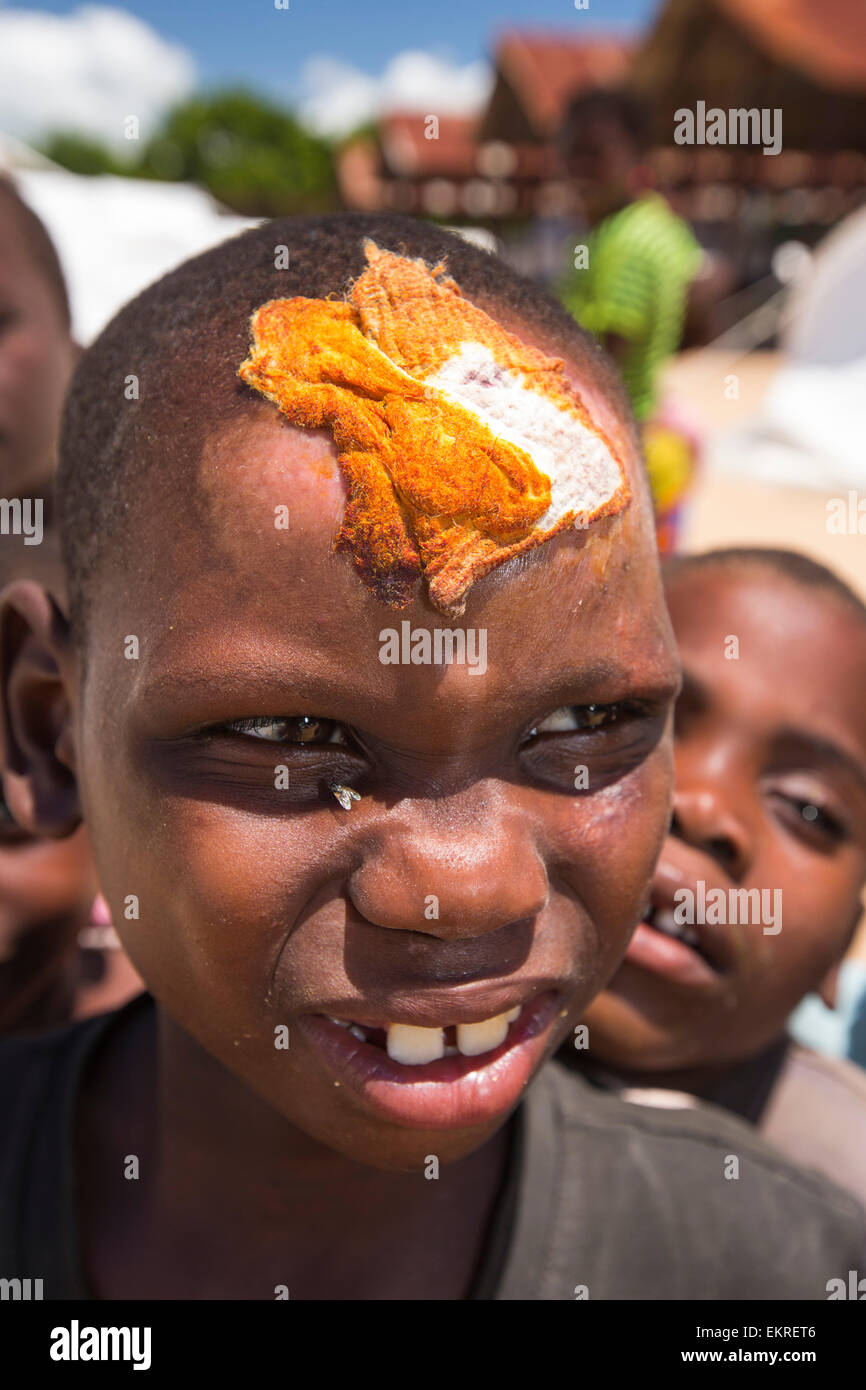 Mitte Januar 2015 ein Zeitraum von drei Tagen der übermäßige regen die kleinen armen afrikanischen Land Malawi beispiellose Überschwemmungen gebracht. Fast ein Viertel von 1 Million Menschen vertrieben, 64.000 Hektar Land verwüstet und mehrere hundert Menschen getötet. Diese Aufnahme zeigt einen jungen, der in den Fluten in einem Flüchtlingslager in Bangula verletzt wurde. Stockfoto