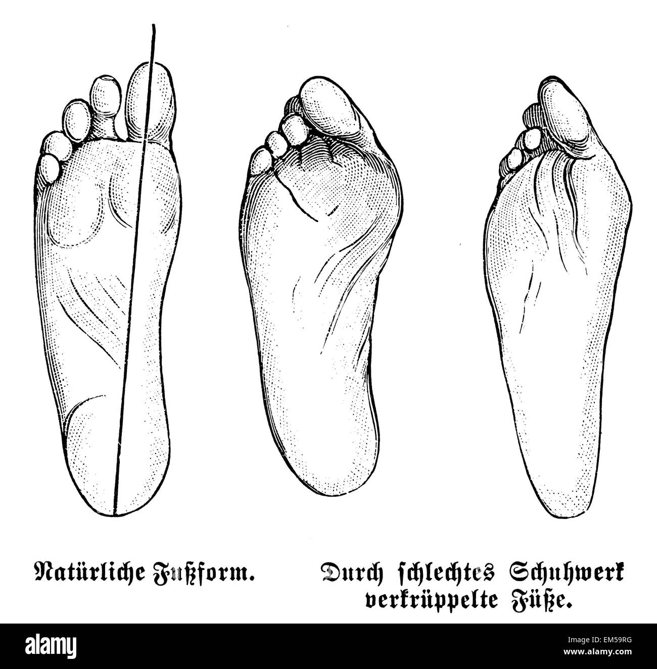 Natürliche Fußform (links) und verkrüppelten Füße durch falsche Schuhe  (Mitte und rechts Stockfotografie - Alamy