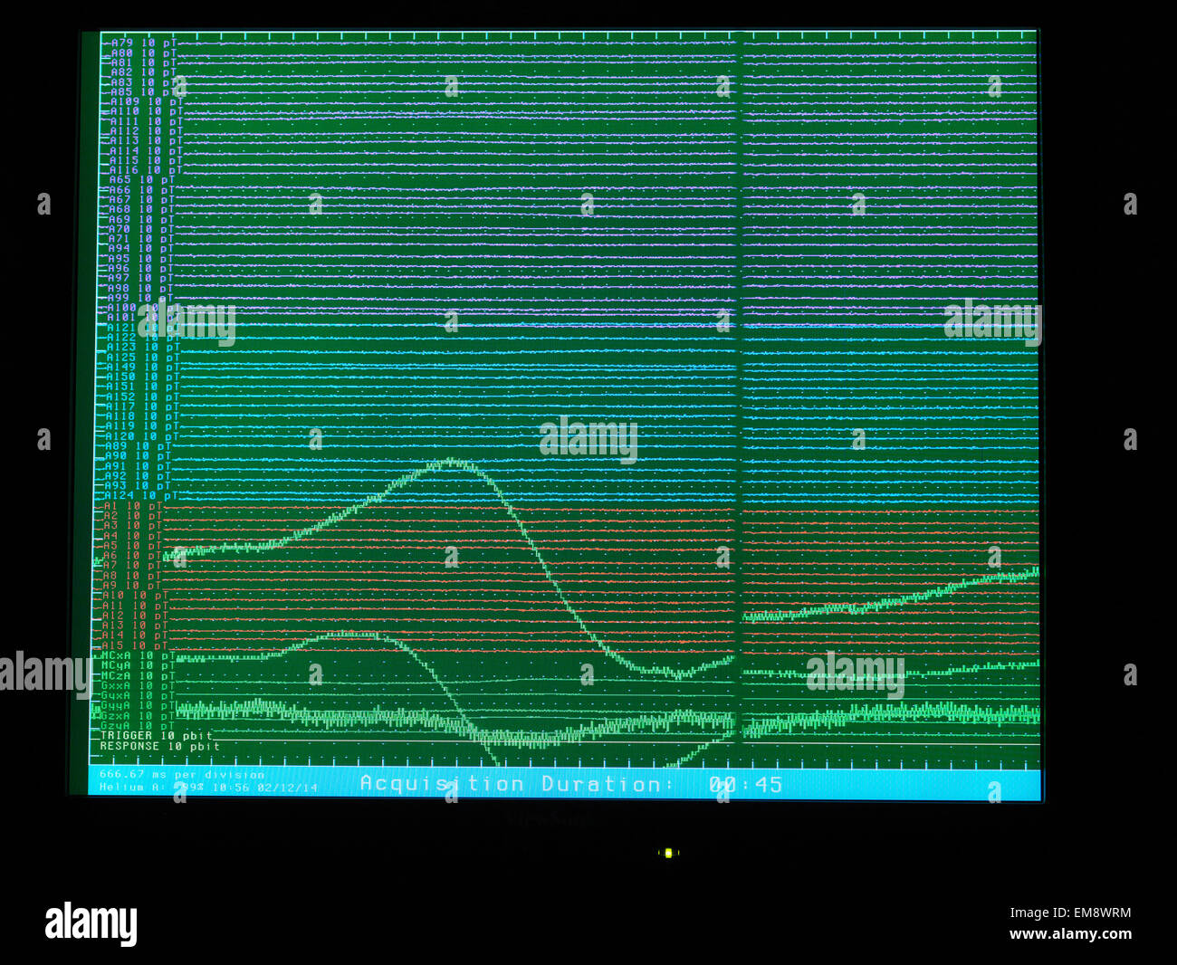 Bildschirm zeigt Magnetoenzephalographie (MEG) scan Stockfoto