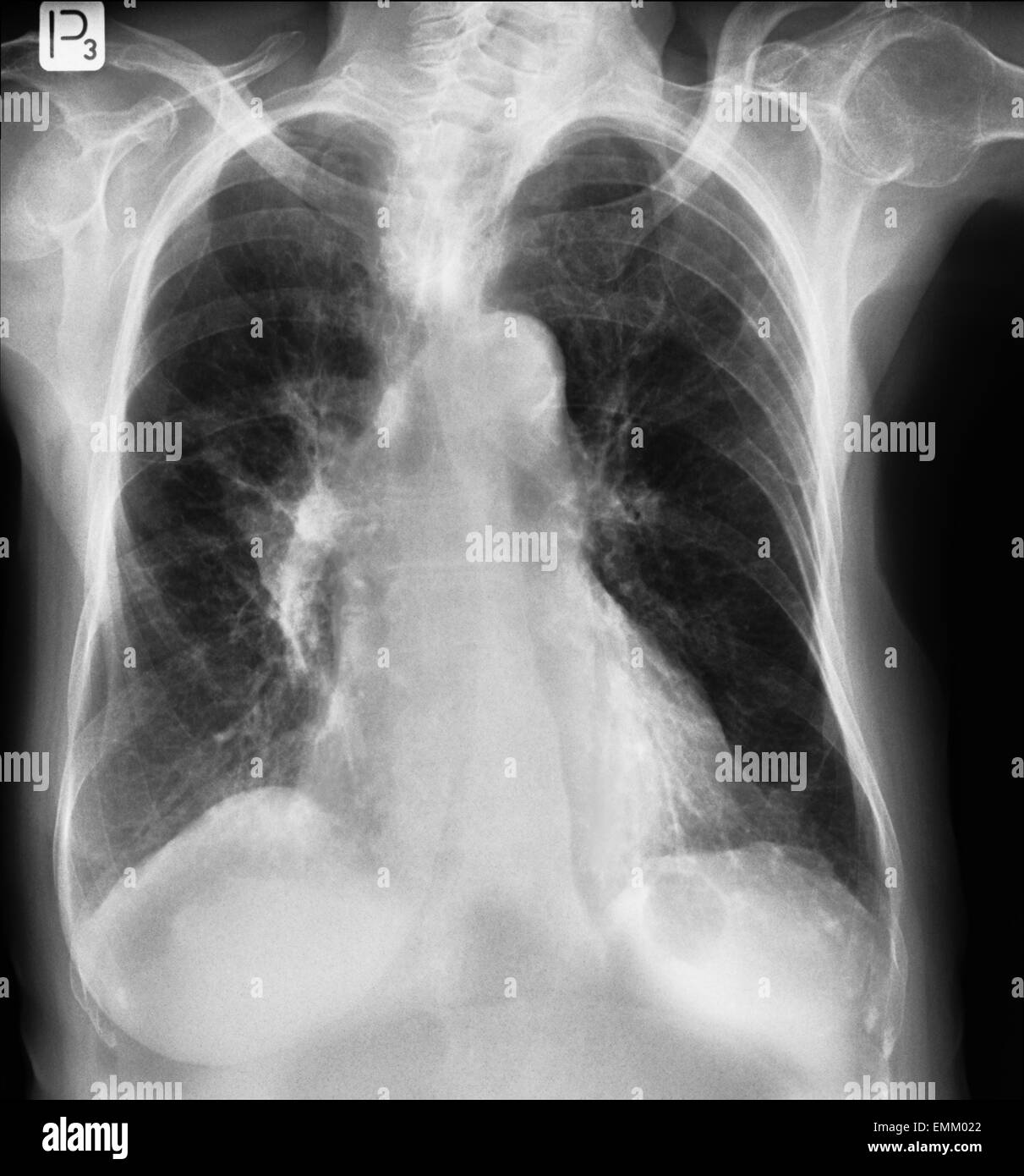 Brust Röntgen während der Lunge, die Tuberkulose auch als MTB oder