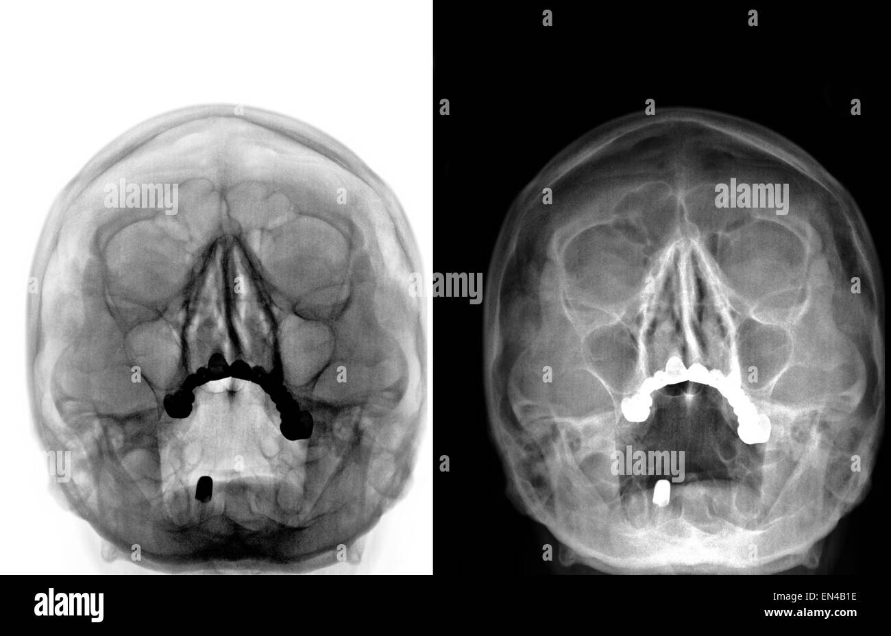 Röntgen-Computertomographie gescannte Bild alte Frau Kopf mit Migräne Stockfoto