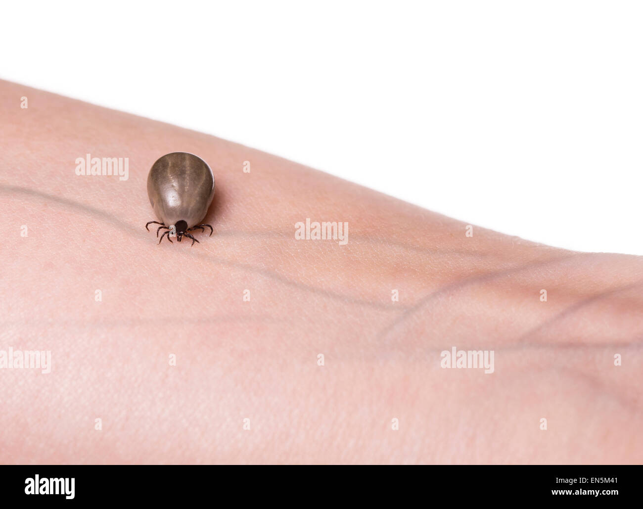 Zecke auf menschlicher Haut kriecht. Stockfoto