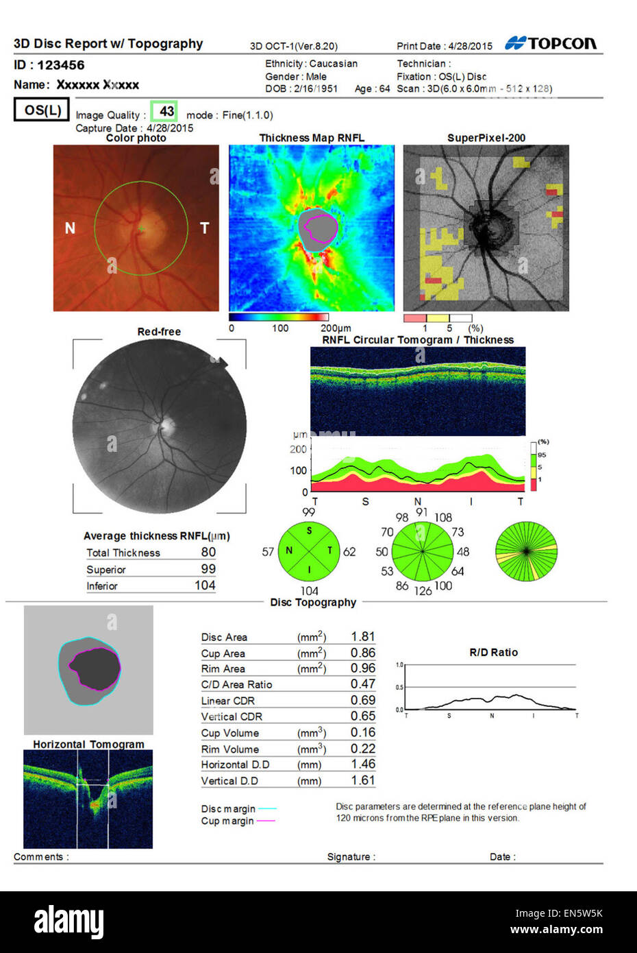 Scan ultra sound Sehtest zeigt 3D Makula-Bericht des menschlichen Auges Vist verschiedene grafische Darstellungen. Stockfoto