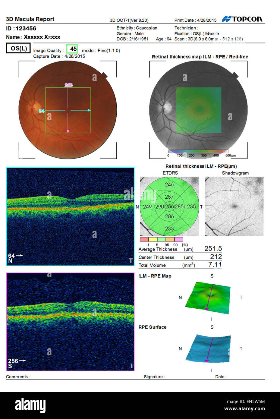 Scan ultra sound Sehtest zeigt 3D Makula-Bericht des menschlichen Auges Vist verschiedene grafische Darstellungen. Stockfoto